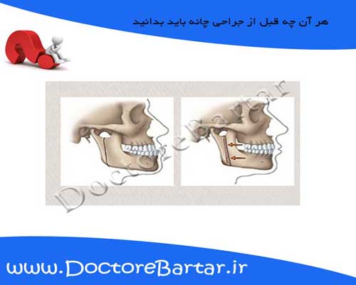 جراحی چانه