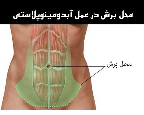 ابدومینوپلاستی چیست