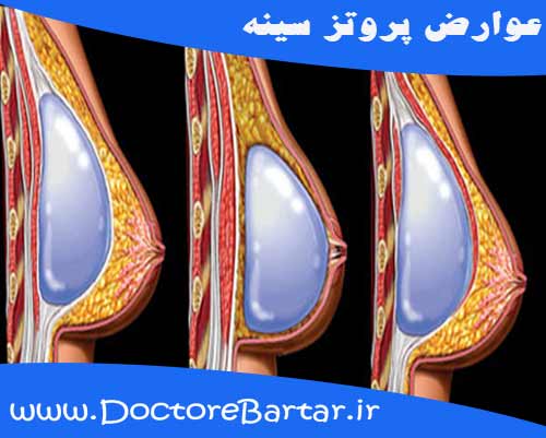 عوارض پروتز سینه