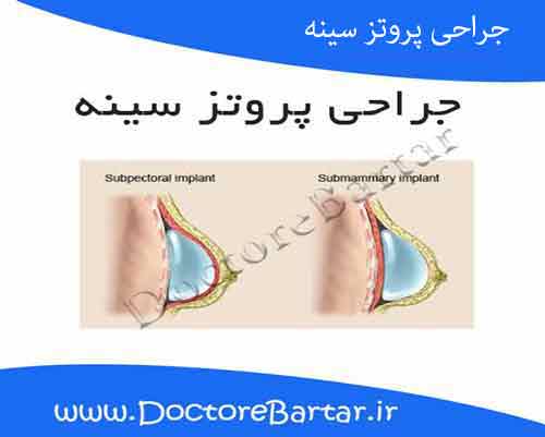 جراحی پروتز سینه