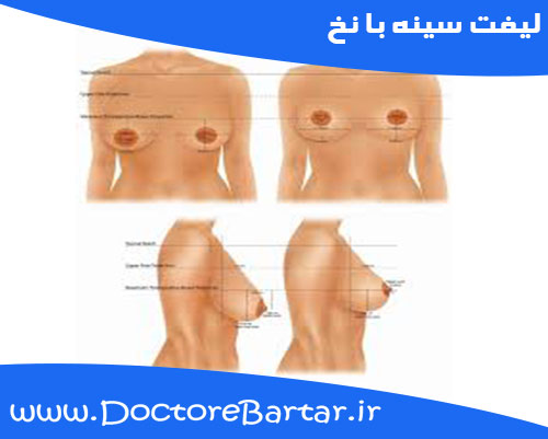 لیفت سینه با نخ