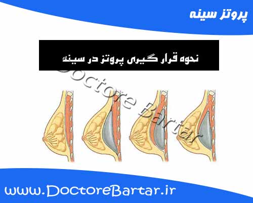 پروتز سینه