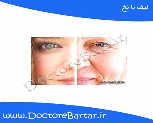 لیفت با نخ