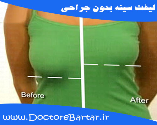 لیفت سینه بدون جراحی