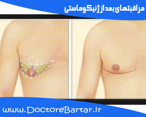 مراقبتهای بعد از عمل ژنیکوماستی