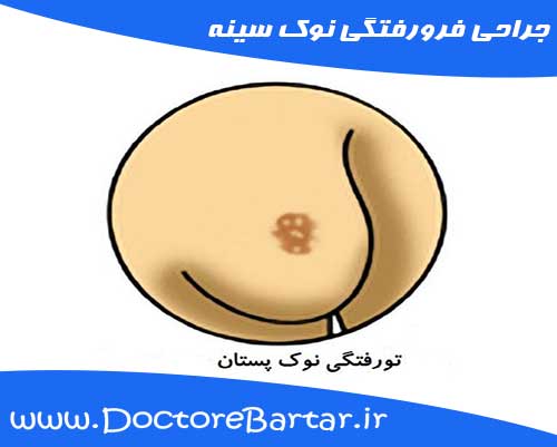 جراحی فرورفتگی نوک سینه