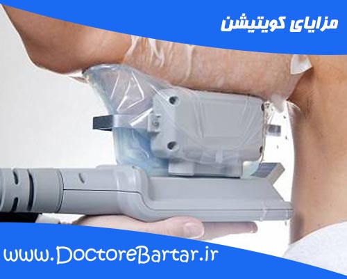 مزایای کویتیشن