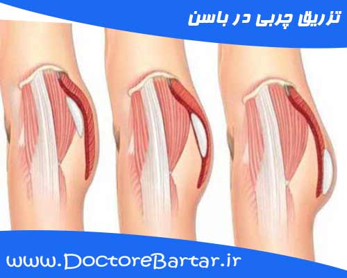 تزریق چربی در باسن