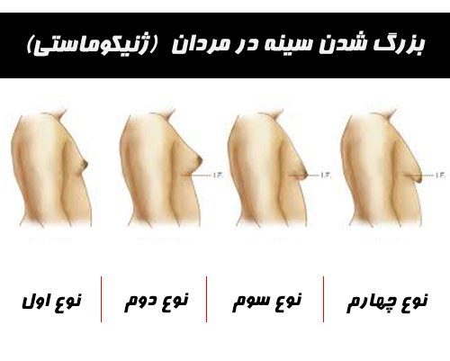بزرگ شدن سینه در مردان یا ژنیکوماستی