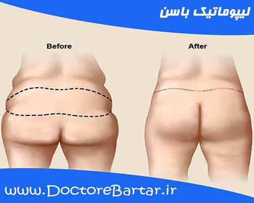 لیپوماتیک باسن