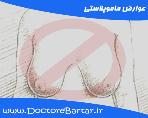 عوارض ماموپلاستی