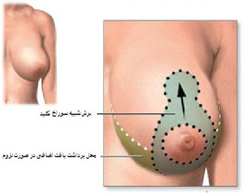 کوچک کردن سینه یا ماموپلاستی