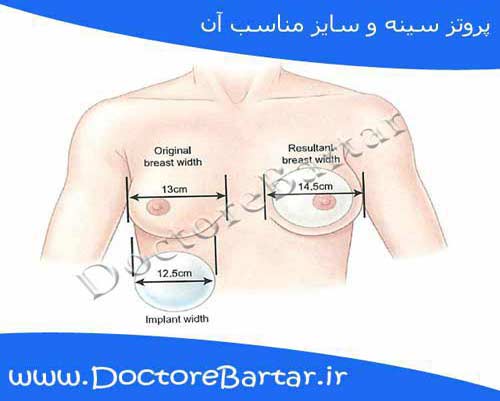 پروتز سینه