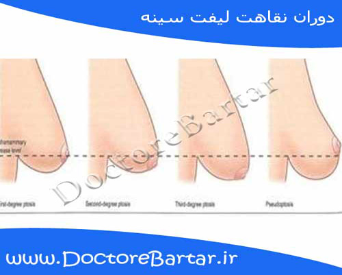 لیفت سینه