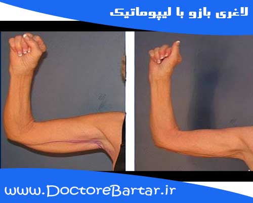 لاغری بازو با لیپوماتیک