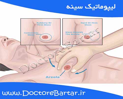 ليپوماتيك سينه