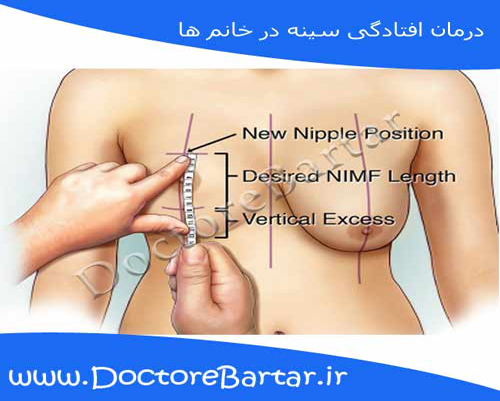 درمان افتادگی سینه در خانم ها