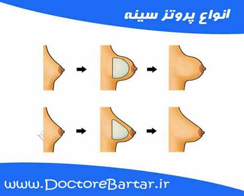 پروتز سینه