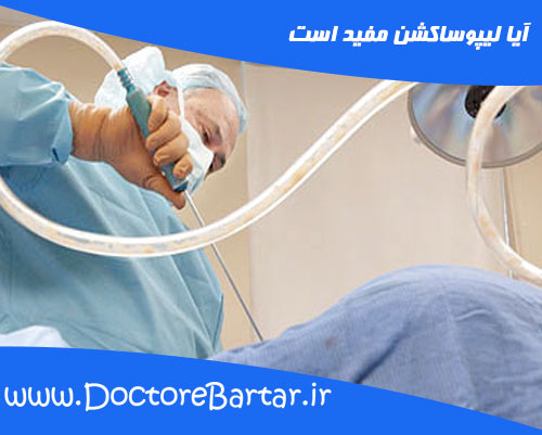 آیا لیپوساکشن مفید است