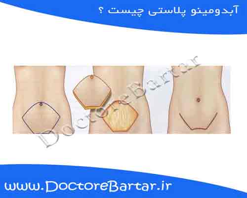 آبدومینو پلاستی