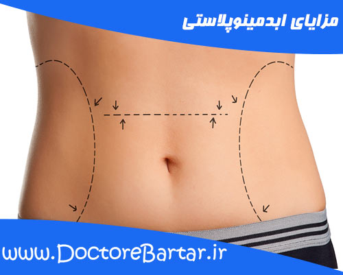 مزایای ابدومینوپلاستی