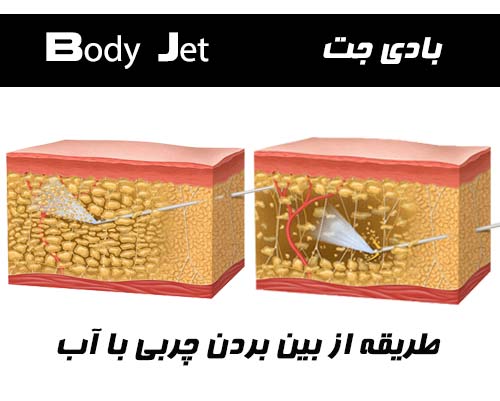 بادی جت برای لاغری