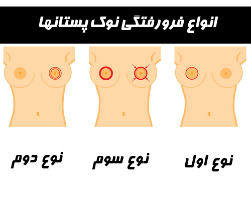 فرورفتگی نوک سینه