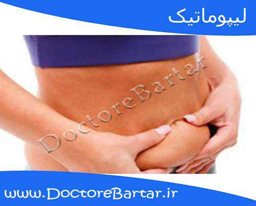لیپوماتیک
