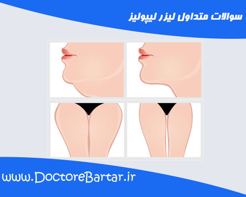 سوالات متداول لیزر لیپولیز