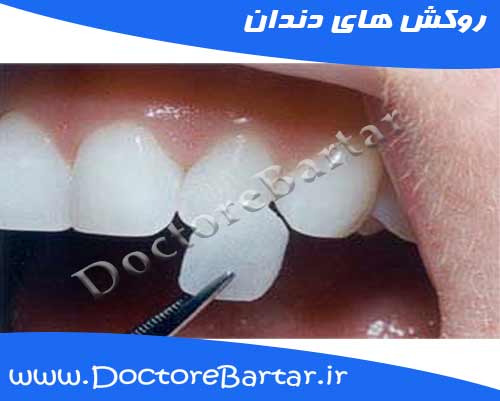 روکش های دندان