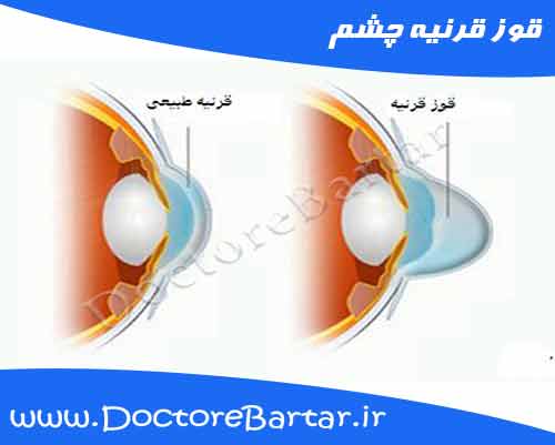 قوز قرنیه چشم