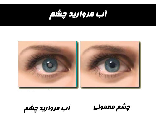 آب مروارید