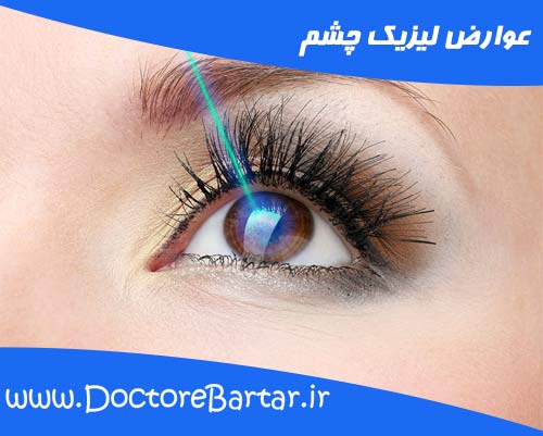 لیزیک چشم