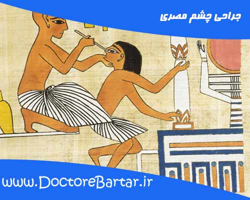 جراحی چشم مصری