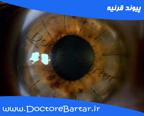 پیوند قرنیه چشم