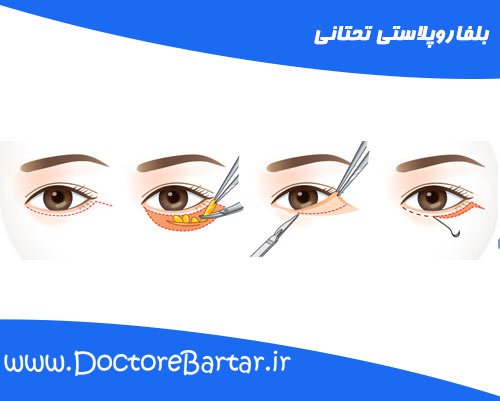 بلفاروپلاستی تحتانی
