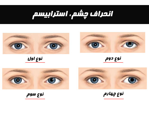 انحراف چشم یا استرابیسم