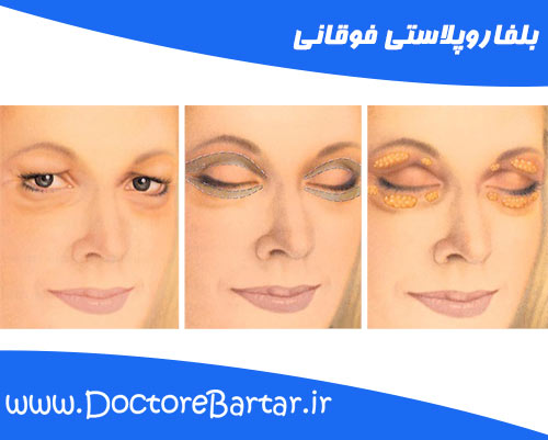 بلفاروپلاستی فوقانی