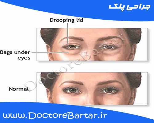 جراحی پلک