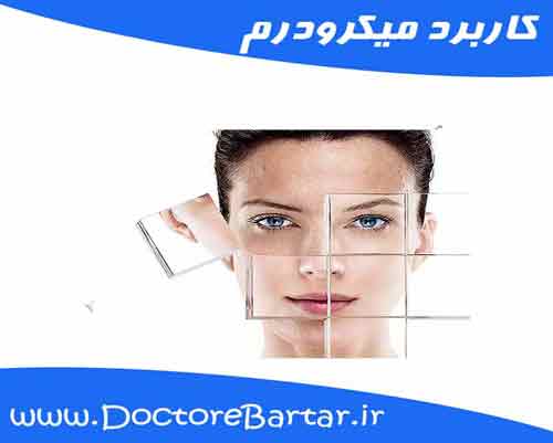 کاربرد میکرودرم