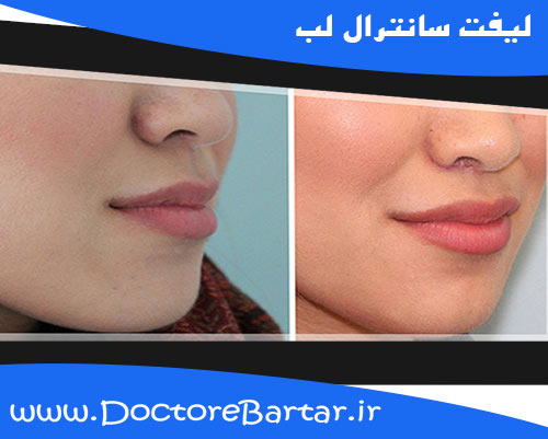 لیفت سانترال لب
