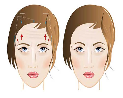 لیفت پیشانی چیست ؟