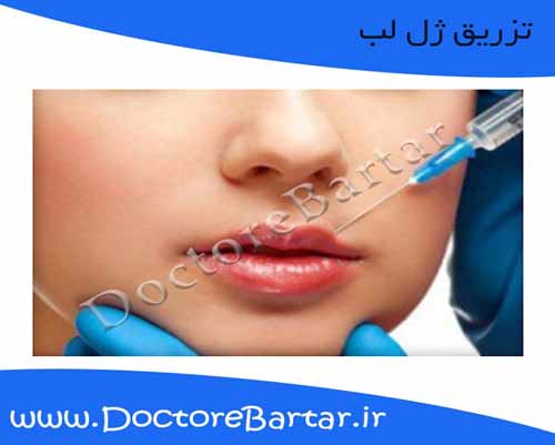 تزریق ژل لب