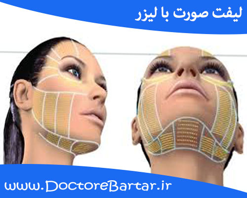 لیفت صورت با لیزر