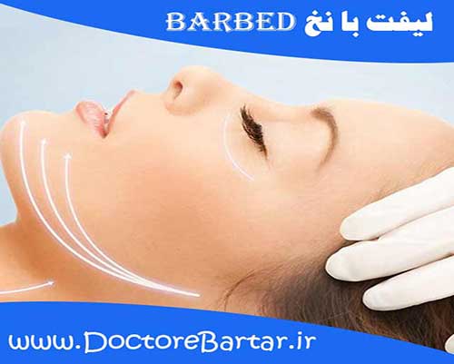 لیفت با نخ barbed