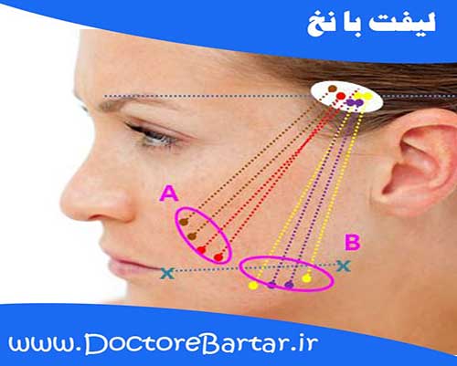 لیفت با نخ