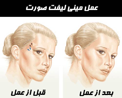 مینی لیفت صورت