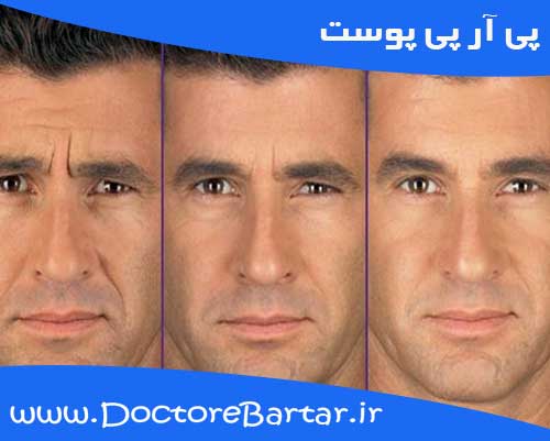 پی آر پی پوست