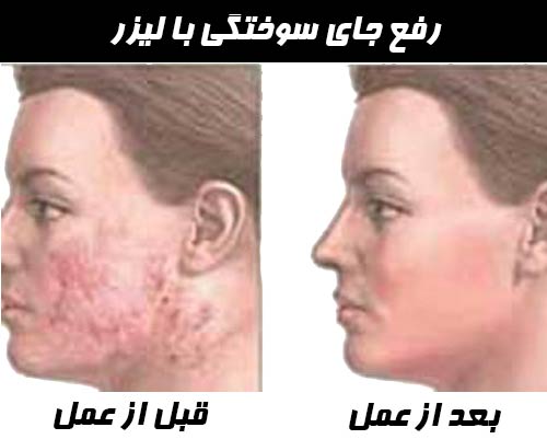 رفع جای سوختگی با لیزر