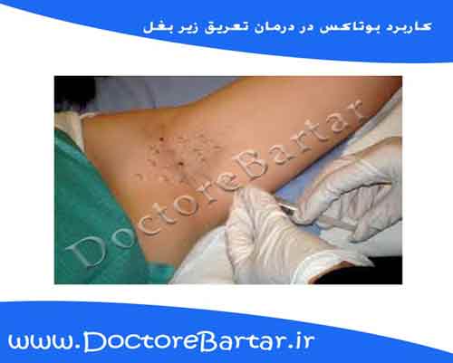 تزریق بوتاکس